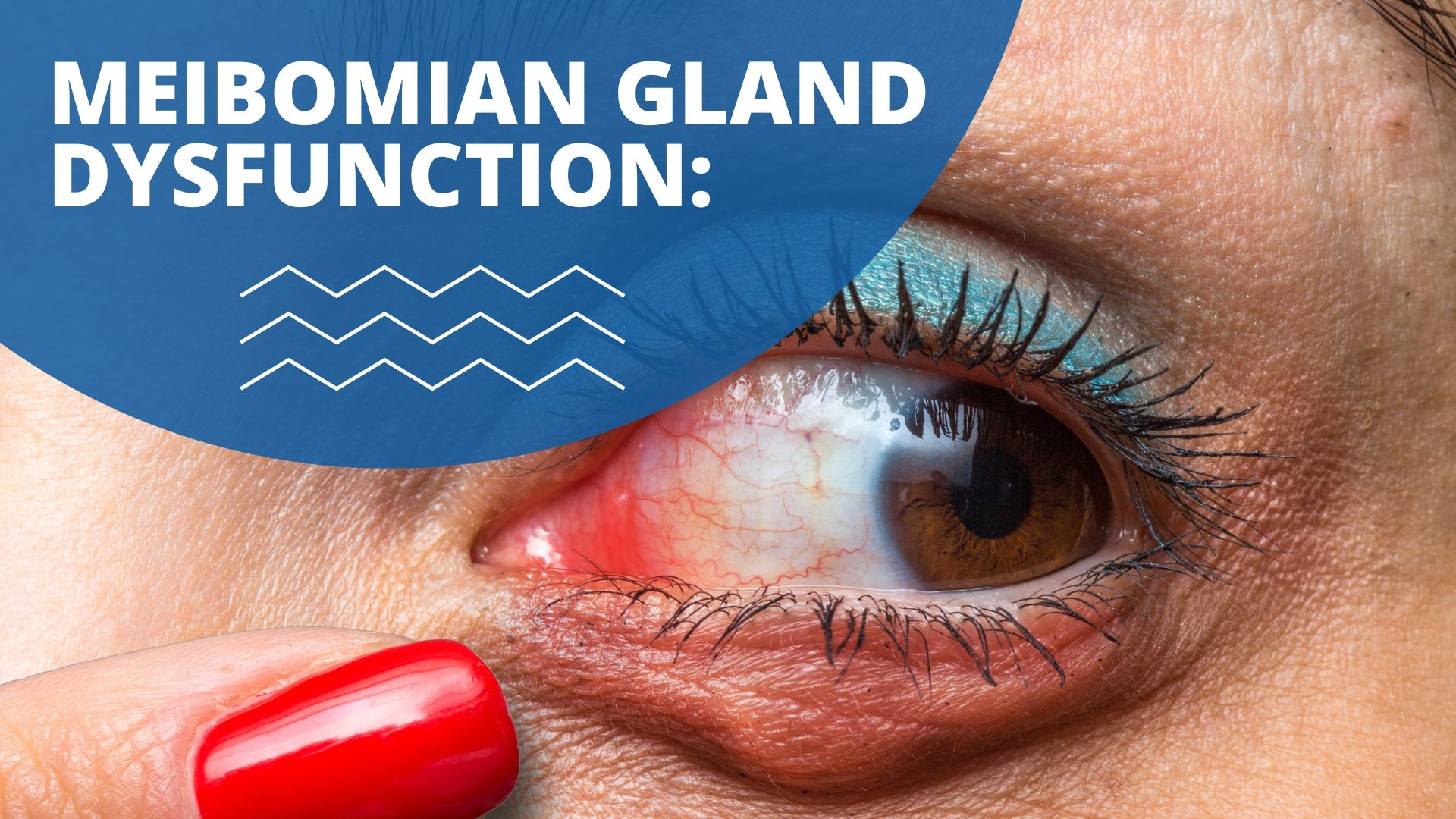 Meibomian Gland Dysfunction Treatment At Northwood Vision