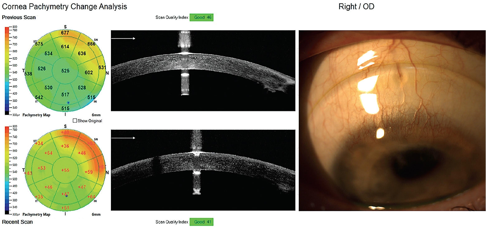 NO FEE CE WORST CASE SCENARIOS Contact Lens Spectrum
